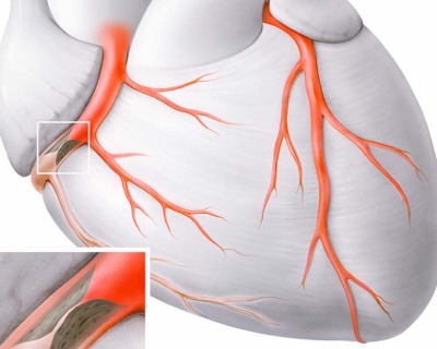 coronary-angiogram
