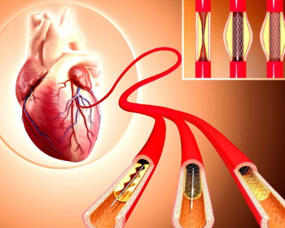 graft-angioplasty
