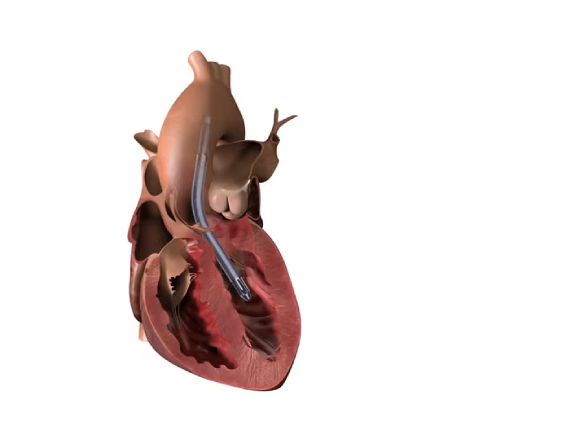 impella
