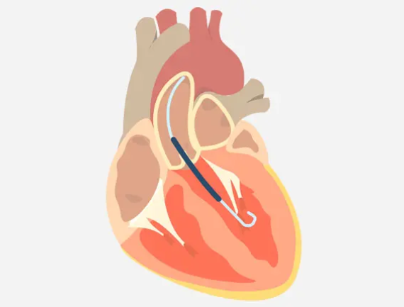 impella2