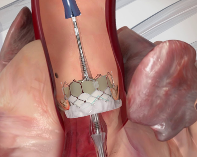 tavi-tavr.png